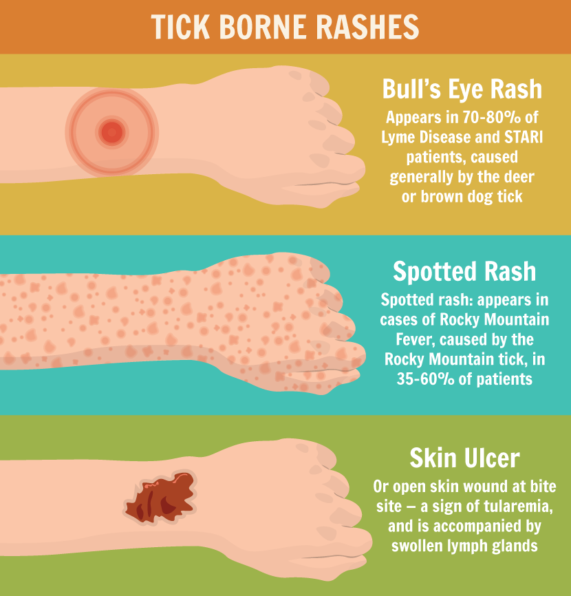 tick bite symptoms in adults